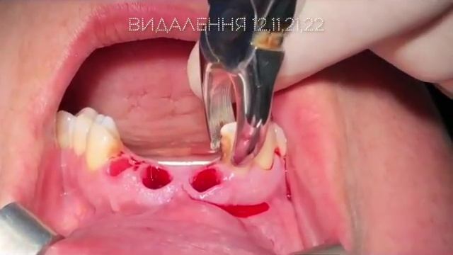 Anterior teeth extraction & socket preservation