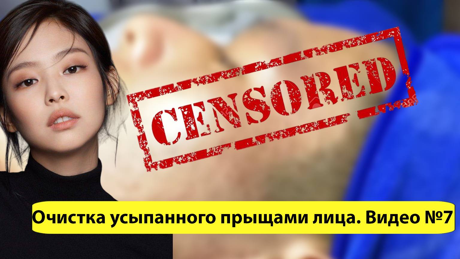 Заканчиваем чистку прыщей на лице. Видео №7