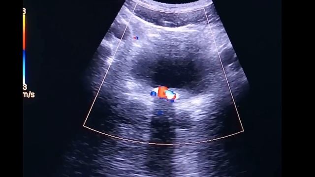 Urinary Bladder Stone On Ultrasound
