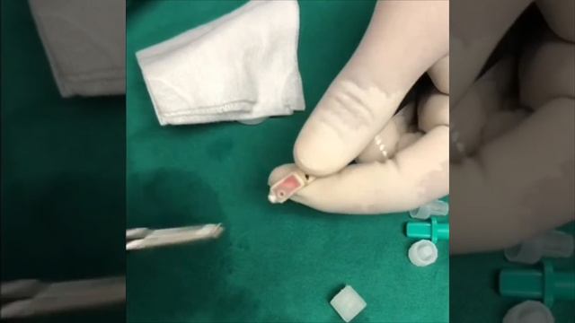 Application of Olympus EBUS scope balloon.