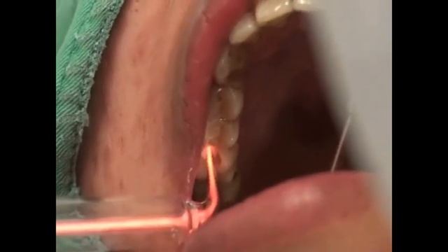 Ozone treatments in multiple cases APOZA's OzoneDTA