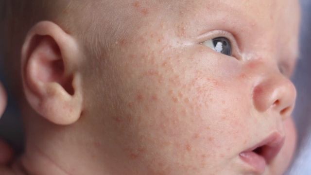 What is Baby Acne? - Boys Town Pediatrics