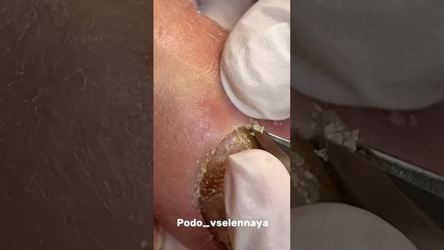 Травма ногтя.