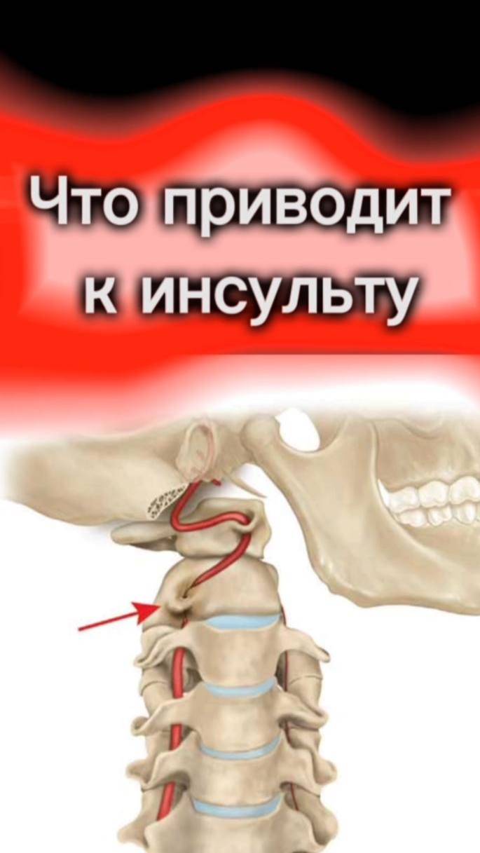 Что приводит к инсульту и как спасает бэм-терапия Fohow