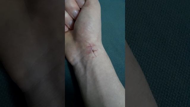 Восстановление руки после операции