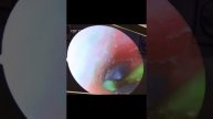 Extremely Itchy Dry Skin & Ear Wax Removal #Short #Wax #Ear 13