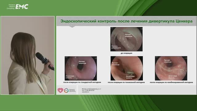 5 Семенова НС, Шишин КВ, Недолужко ИЮ, Пятакова АВ Отдаленные результаты лечения дивертикула Ценкера