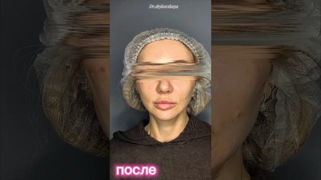 Мила Сбыковская нитевой лифтинг подтяжка