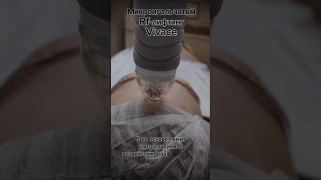 Микроигольчатый Rf-лифтинг #skincare #косметология #красотакожи #уходзалицом #rfлифтинг