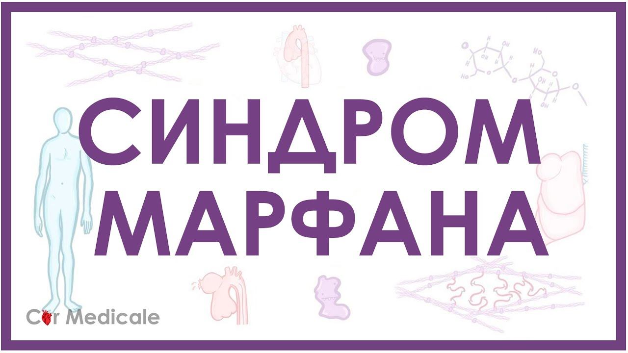 Синдром Марфана - механизм развития, причины, клинические проявления