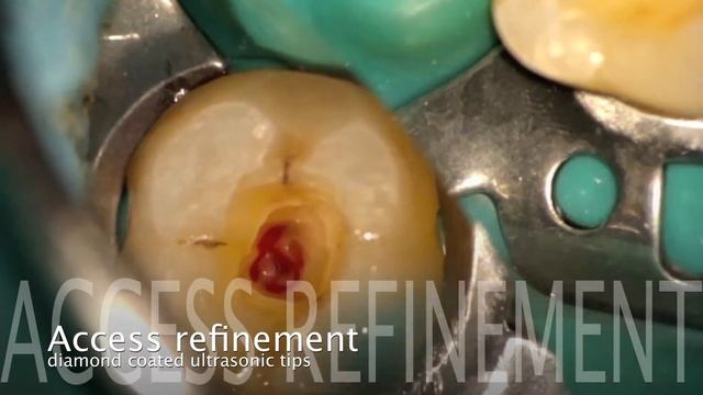 Endodontic Access