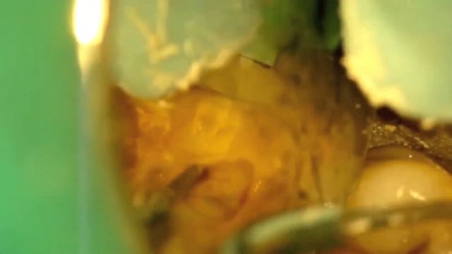 Endodontic access, dealing with Hess anatomy