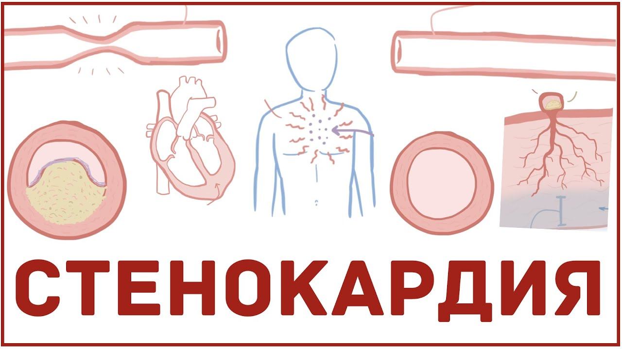 Стенокардия кратко - виды, причины, симптомы, лечение