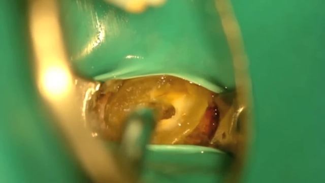Troughing out for a calcified canal