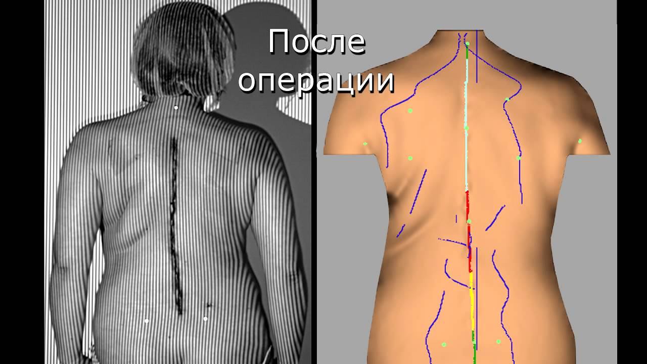 Оценка результатов хирургического лечения сколиоза методом компьютерной оптической топографии