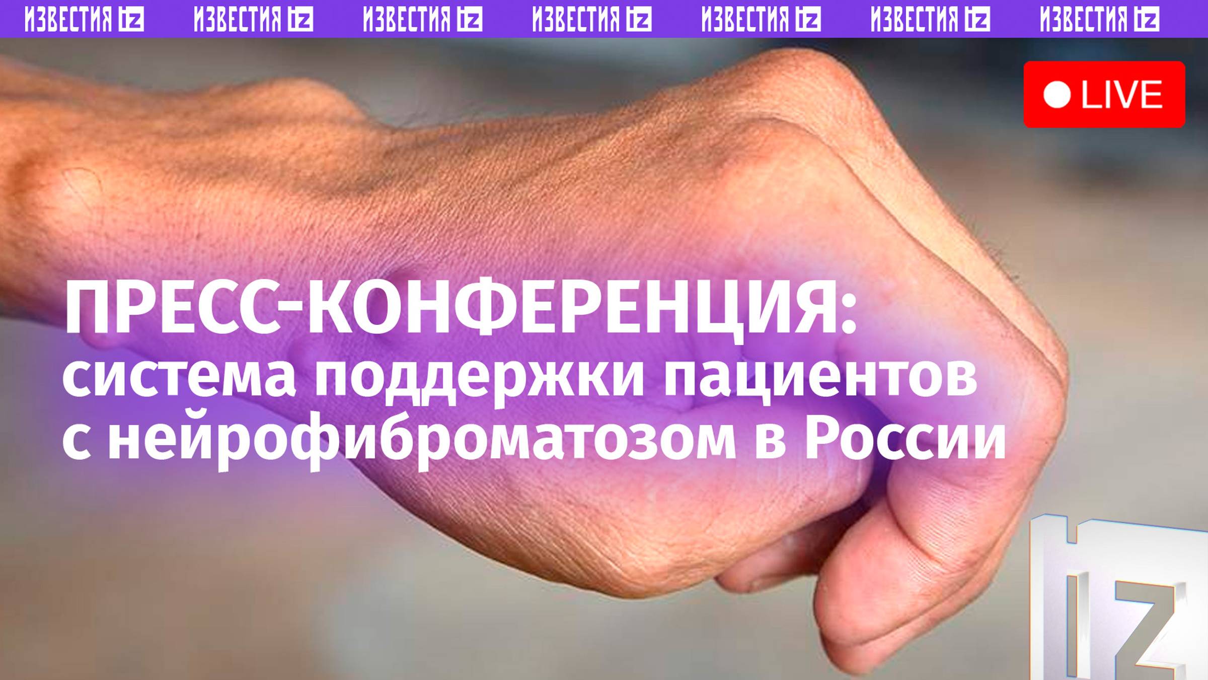 Текущую ситуацию с заболеваемостью нейрофиброматозом в России обсуждают в МИЦ «Известия»