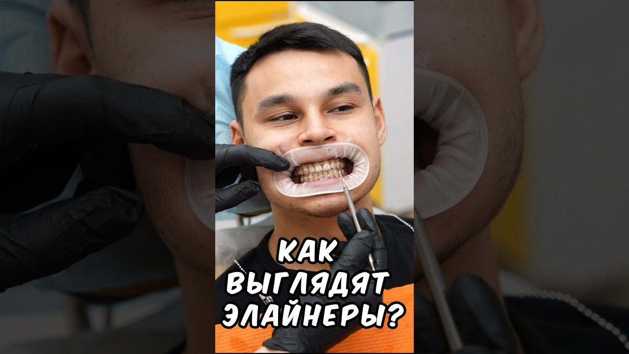 Элайнеры для исправления прикуса #андрейзорин #стоматология #элайнеры