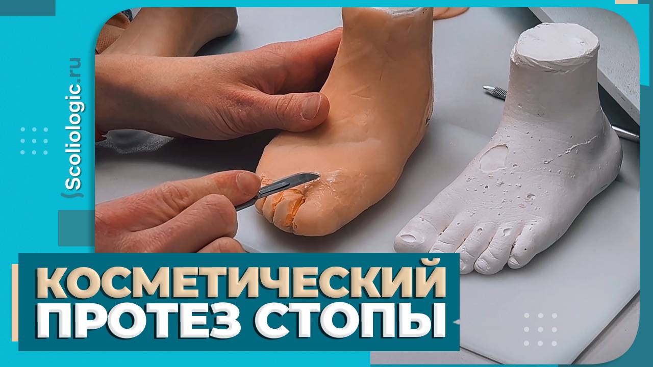 Косметический протез стопы для ребенка