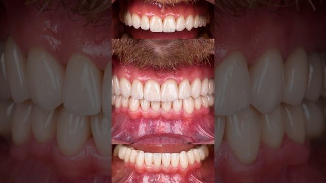 Виниры на стертые зубы