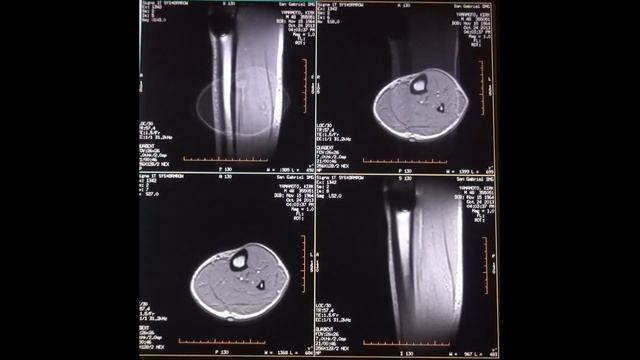 Echospeed 1.0T Mobile MRI