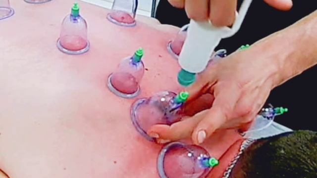 Постановка медицинских вакуумных банок.
