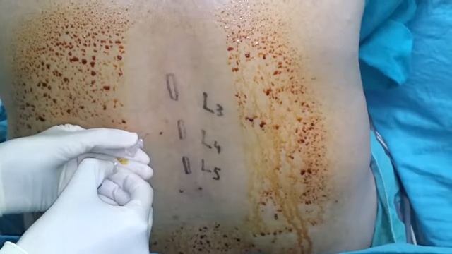 Lumbar Puncture(Spinal Tap)