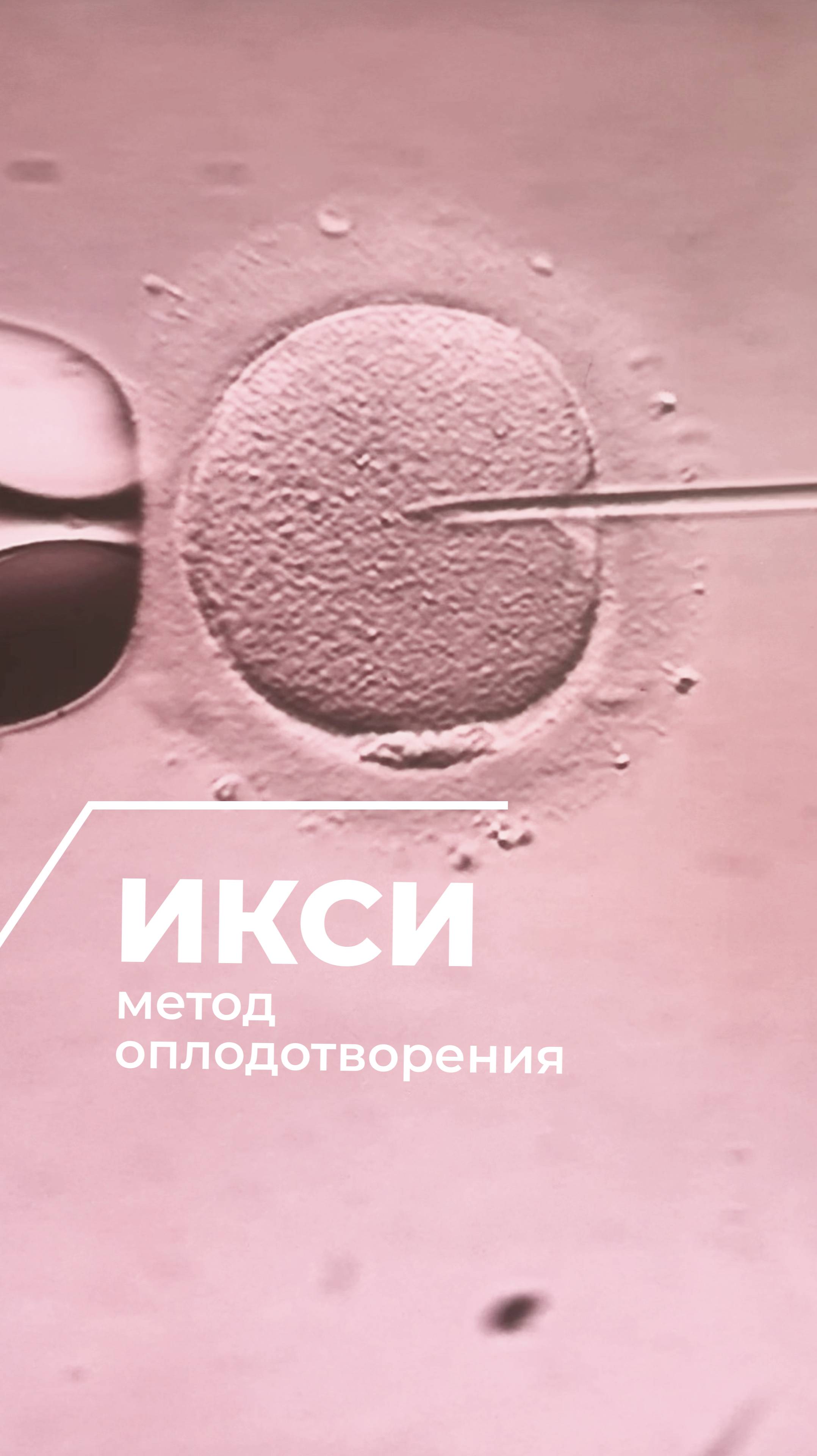 🤩ПРОЦЕСС ОПЛОДОТВОРЕНИЯ МЕТОДОМ ИКСИ!