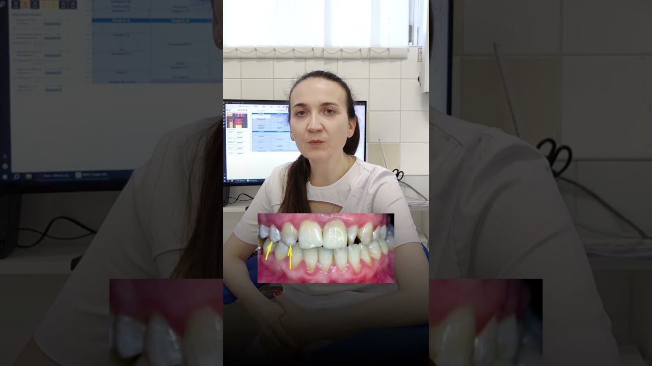Пятна на зубах
