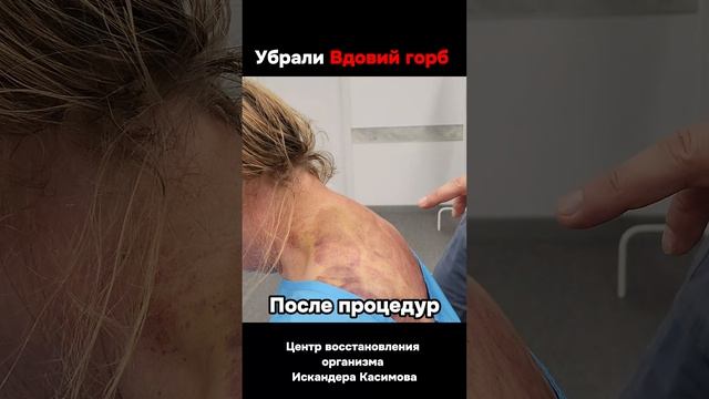 Убрали Вдовий горб! Холка на шее