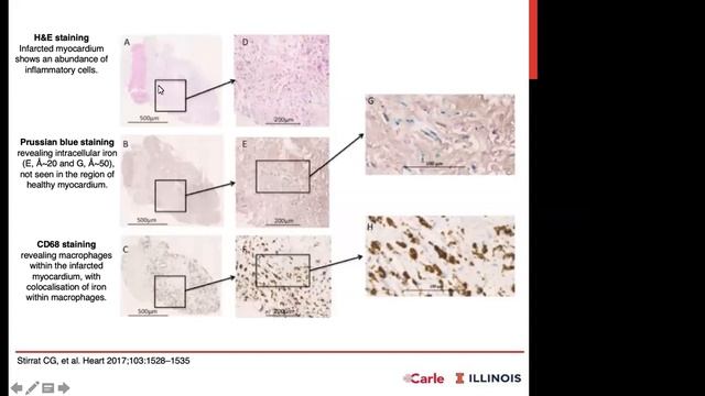 "Do Heart Attacks Cause Brain Inflammation? The Emerging Field of Cardio-Neuro-Immunology" 6/11/21