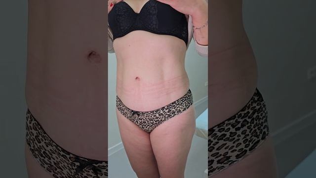 Абдоминопластика. Год после операции.