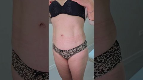 Абдоминопластика. Год после операции.