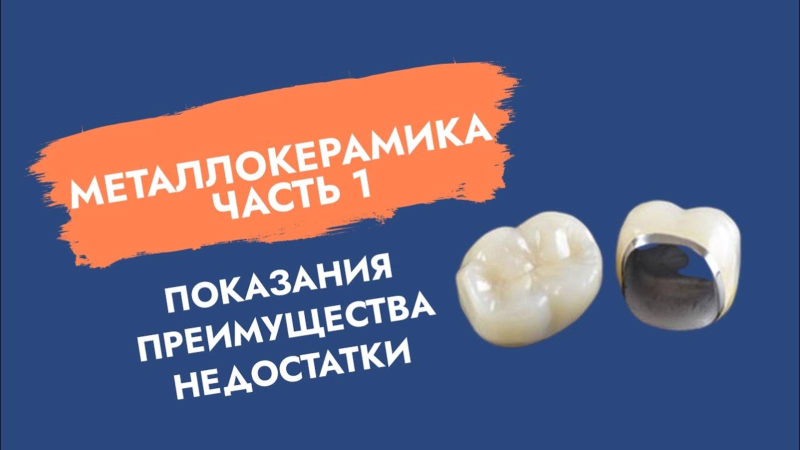 Металлокерамика. Что должен знать пациент?