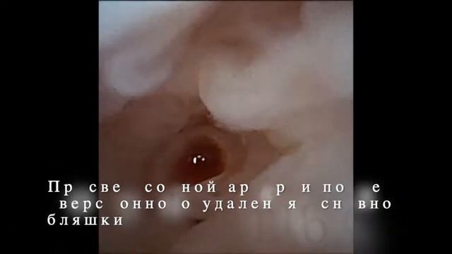 Каротидная эндартерэктомия с использованием наноскопа. Нейрохирургия. Операция.