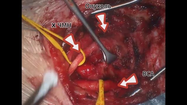 Удаление вагальной параганглиомы