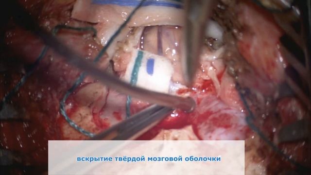 Оперативное лечение аномалии Киари I типа