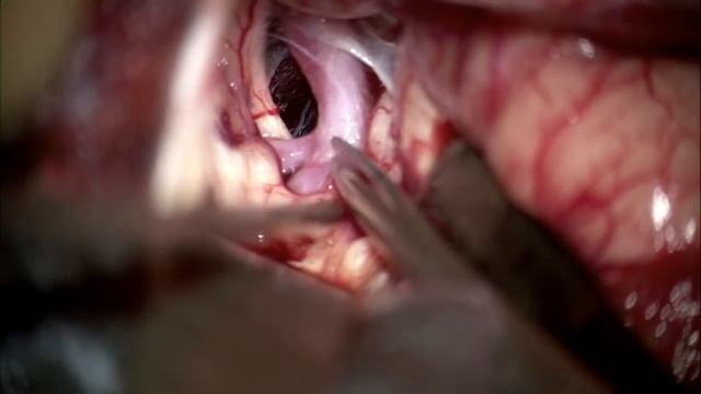 Клипирование аневризмы бифуркации внутренней сонной артерии. Нейрохирургия. Операция.