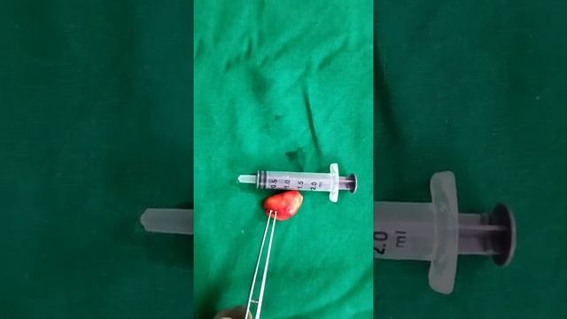 Intact Post Aural Epidermoid /Sebaceous Cyst Removed