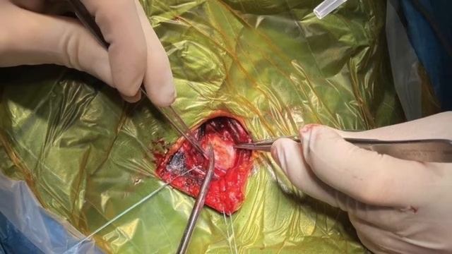 Транспозиция устья левой позвоночной артерии в общую сонную артерию. Нейрохирургическая операция.