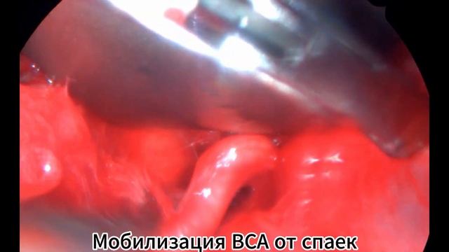 Патологическая извитость левой внутренней сонной артерии