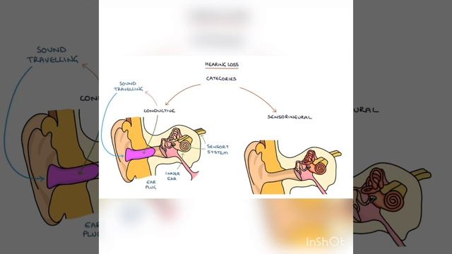 Hearing Loss