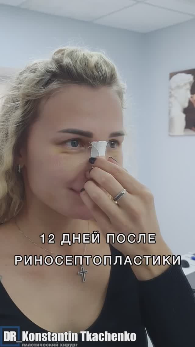 Продолжение с данной пациенткой.
В конце смотрите видео ДО операции.