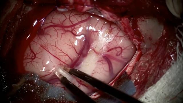 Амигдалогиппокампэктомия у ребенка с фармакорезистентной эпилепсией. Нейрохирургическая операция