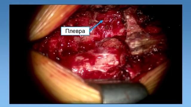 Операция удаление экстра-интрадуральной опухоли (невриномы) на уровне тел Th12-L1 позвонков.