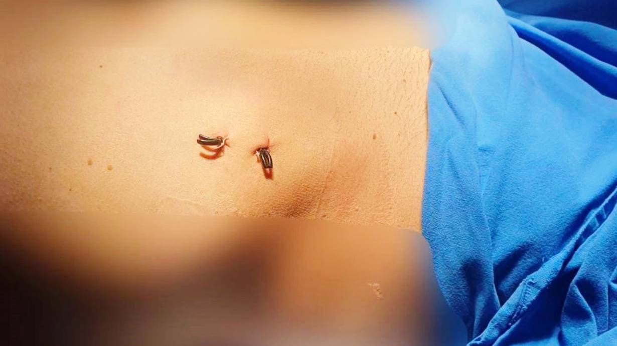 Сургутские врачи разрабатывают новый стандарт в хирургии