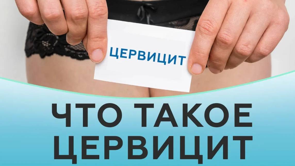 Что такое цервицит. Эндоцервицит и экзоцервицит