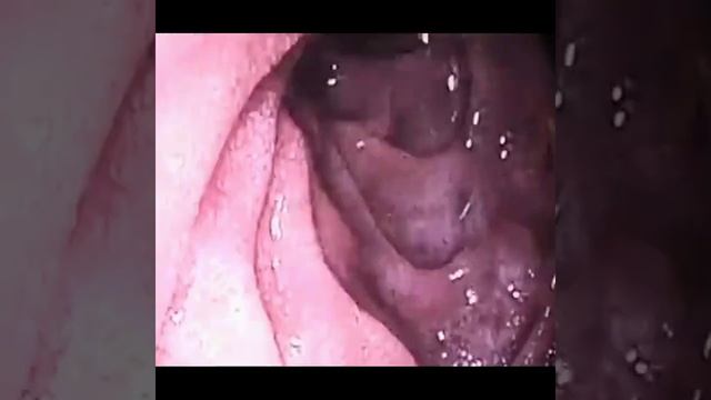 Endoscopy upper GIT