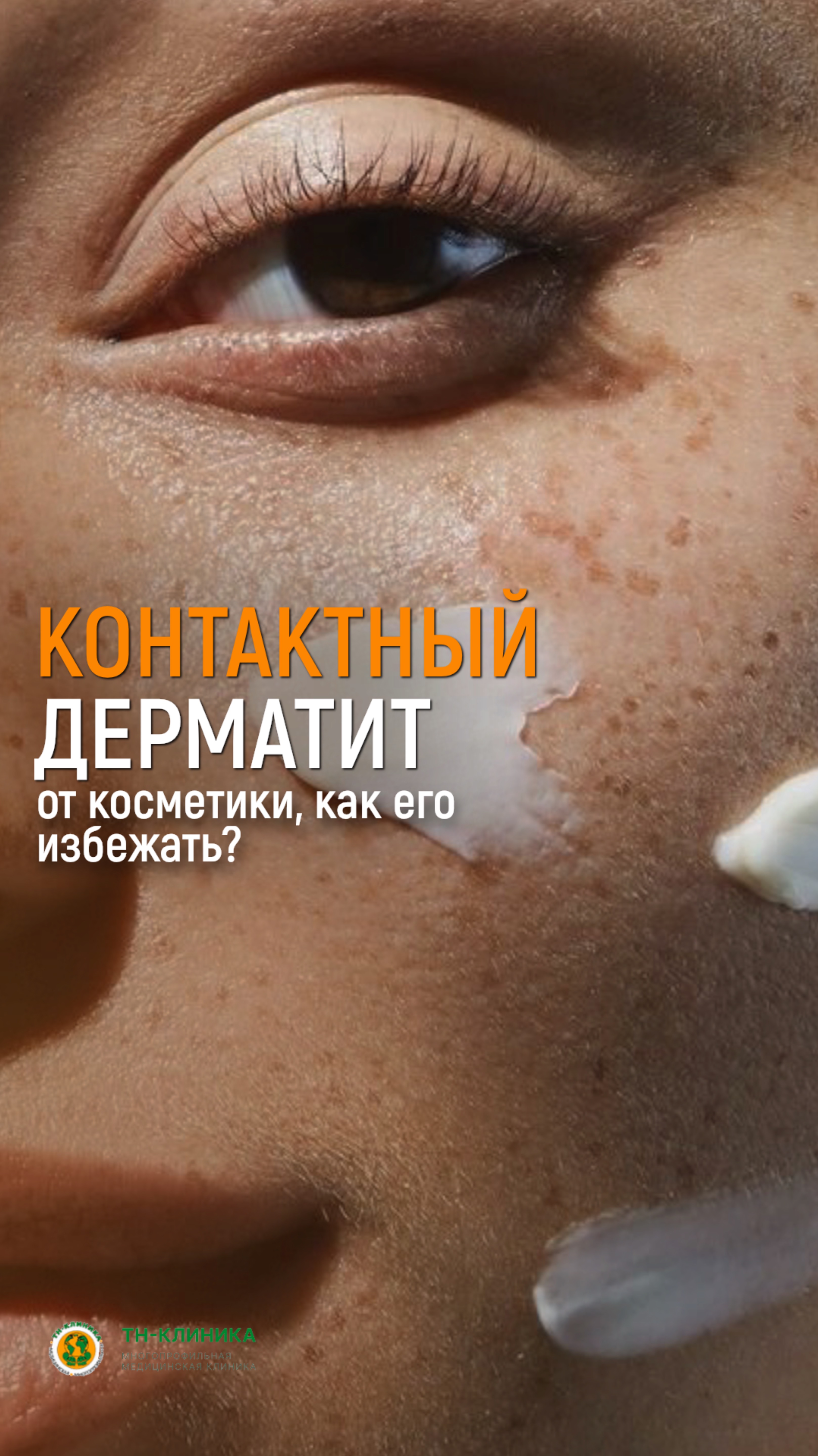 Контактный дерматит