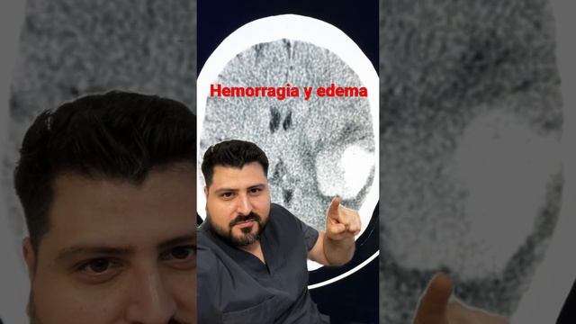 Derrame Cerebral #tomografia  #hipertensión  #cefalea  #enarm #cto #radiologia #ancianos