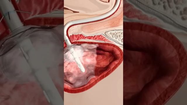 urinary catheter